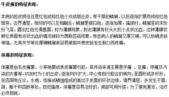 怎樣通過(guò)臨床表現(xiàn)來(lái)辨別牛皮癬和體癬