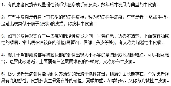 如何通過(guò)癥狀表現(xiàn)來(lái)診斷判斷牛皮癬