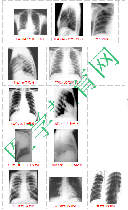 快收藏！臨床助理醫(yī)師實踐技能62個胸片（圖片診斷）