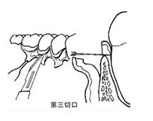 翻瓣術