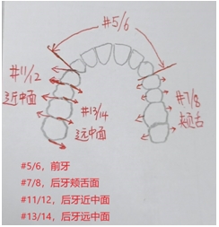 齦下刮治術(shù)