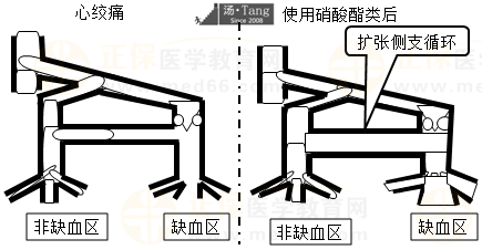 心絞痛